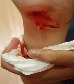 اربد .. اصابة طالب بجراح بالغة اثر ارتطام يده بزجاج مكسور داخل مدرسة