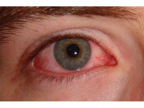 تعرف على أعراض ومسببات إنفلونزا العيون