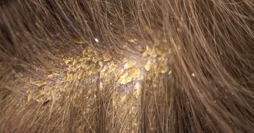 كيفية علاج أكزيما الشعر الدهني بالأعشاب