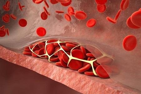 عامل مفاجئ يزيد من خطر الإصابة بتجلط الدم
