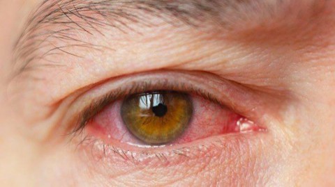 جفاف العين في شهر رمضان: الأسباب والعلاجات الطبيعية