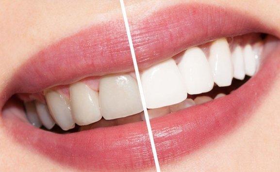 4 خطوات مهمة قبل تبييض الأسنان