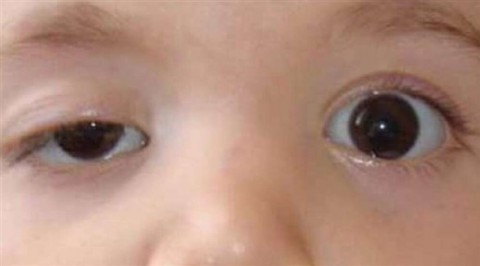 “العين الكسولة: إشارة إلى مشكلات صحية أكثر خطورة مما يعتقد البعض”