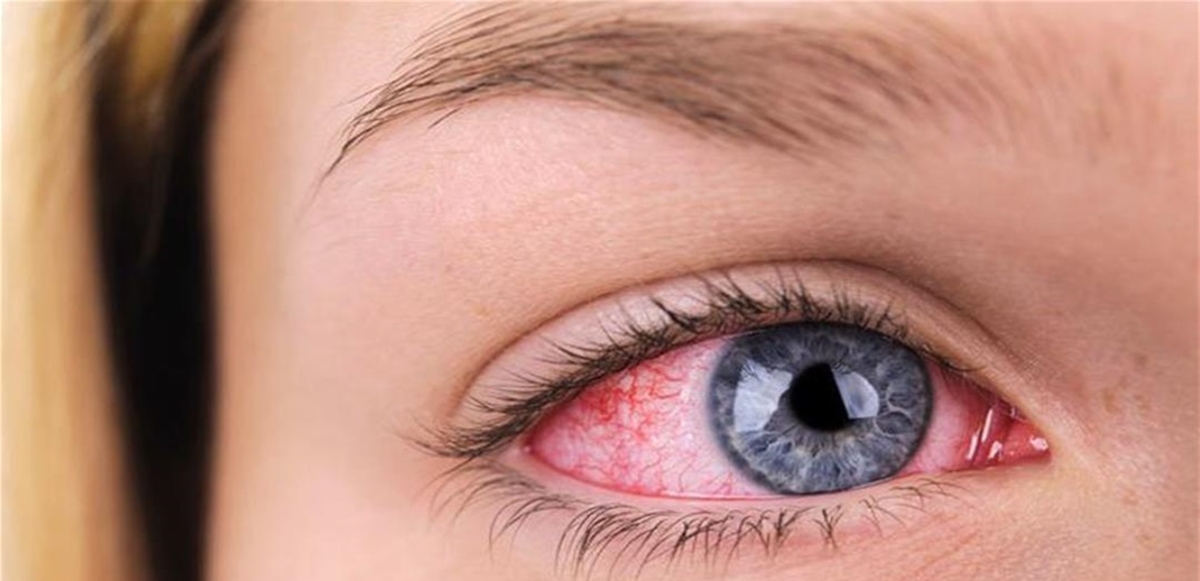 للتخلص من جفاف العين.. طرق تساعد فى العلاج