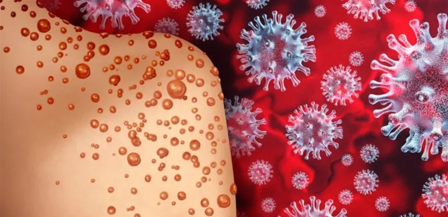 لا يُعرف عنه الكثير ويُثير مخاوف عالمية.. نيويورك تؤكد أول إصابة بجدري القردة