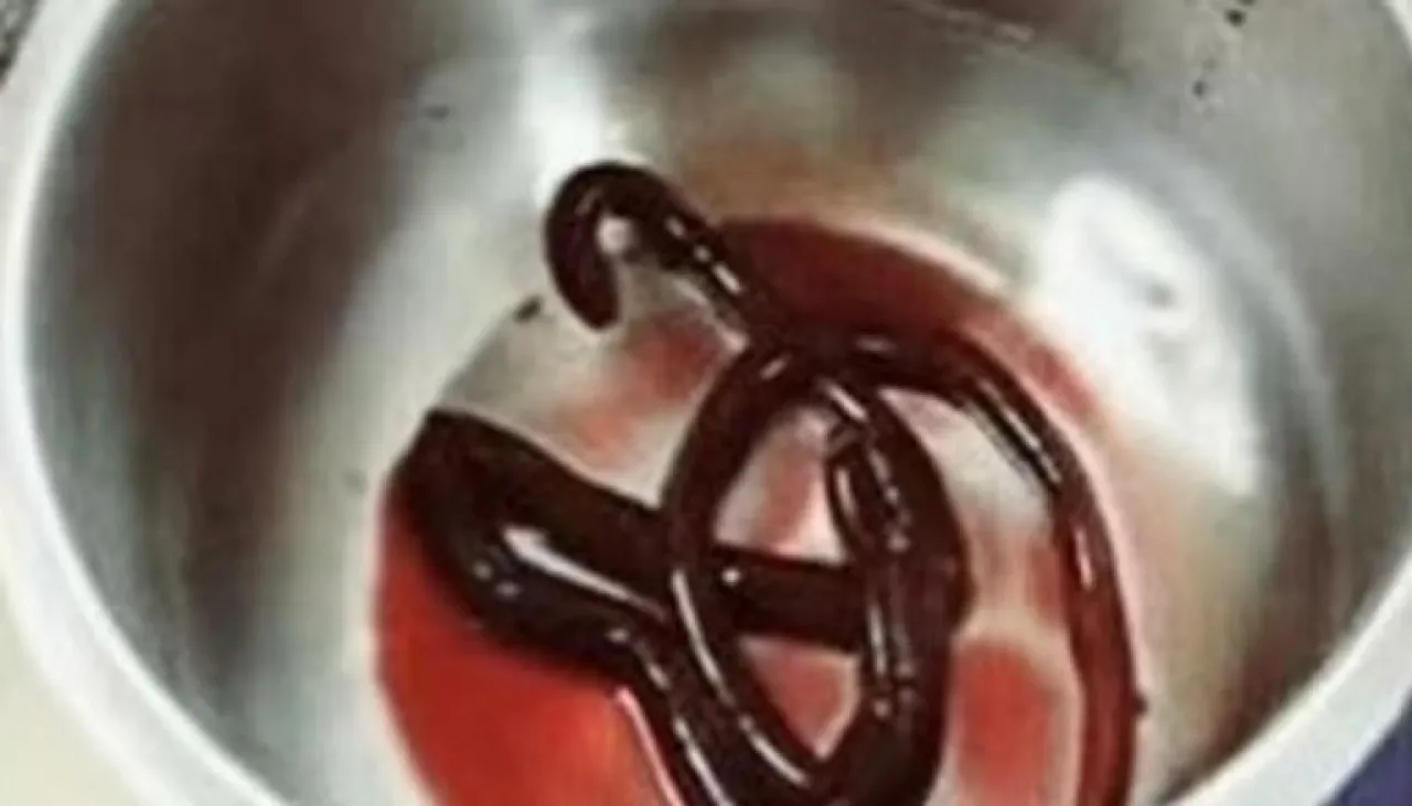 صورة لا تُصدق.. دودة نادرة بطول 30 سم تتسلل إلى جسد مريض