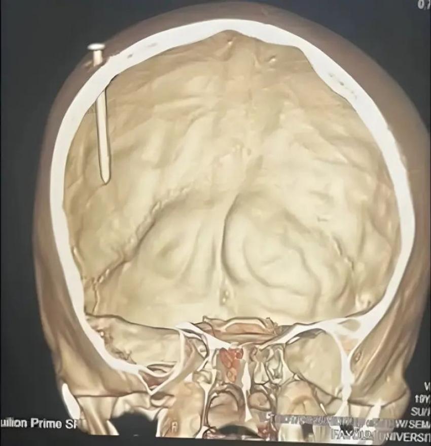 تدخّل جراحي نادر أنقذ طفلا مصريًا