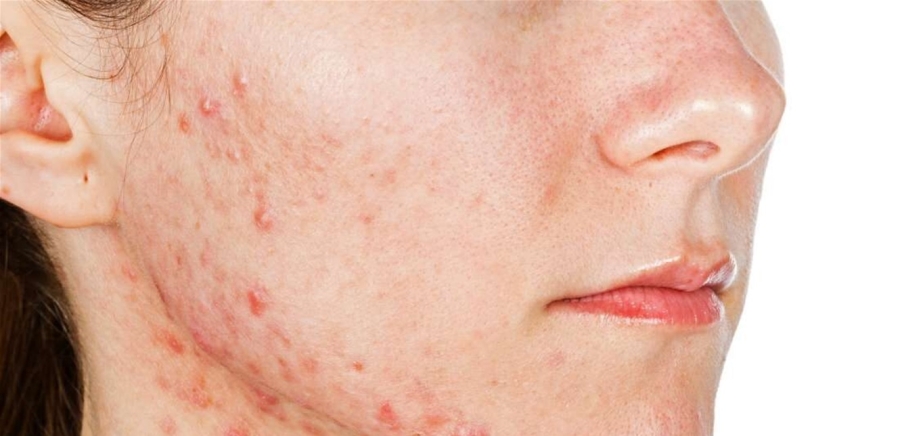 لماذا تظهر حبوب البشرة لدى النساء؟ نصائح طبية لعلاجها بفعالية