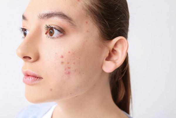 حلول فعّالة للتخلص من الحبوب واستعادة صفاء البشرة