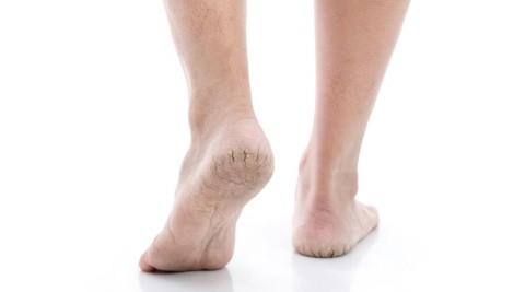 تشققات الكعبين في الصيف: الأسباب والحلول لتنعمي بقدمين ناعمتين كالمخمل