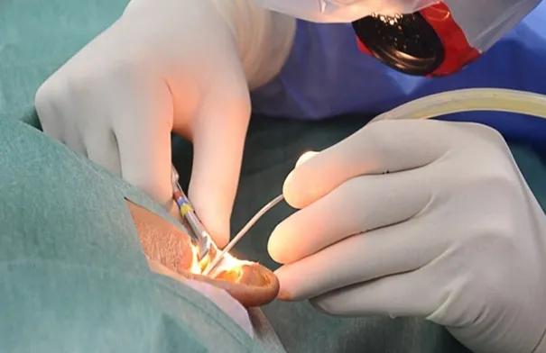 عملية ناجحة باستخدام المنظار لإزالة تسوس الأذن بمستشفى الأميرة بسمة