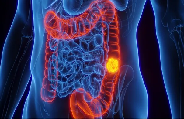 نوع شائع من التوابل قد يحارب سرطان الأمعاء القاتل