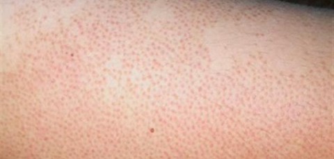 جلد الدجاجة (التقرن الشعري): الأسباب، العلاجات الطبيعية، وأهم النصائح للعناية بالبشرة