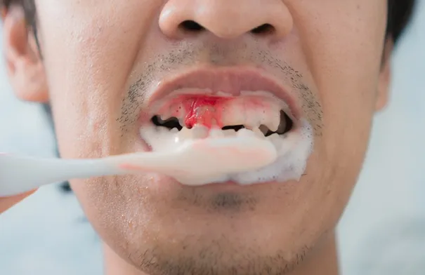 طبيب يحذر: نزيف اللثة ليس أمرا طبيعيا