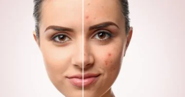 وصفات طبيعية للتخلص من آثار حب الشباب على البشرة