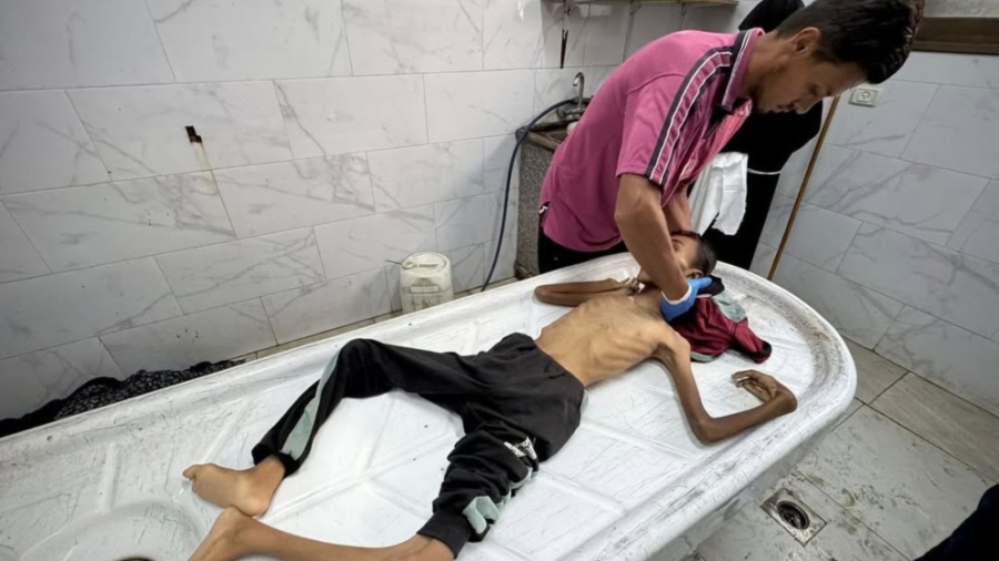 وفاة فتى بسبب سوء التغذية في غزة