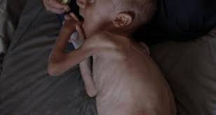 7 وفيات في غزة نتيجة الجوع خلال 24 ساعة