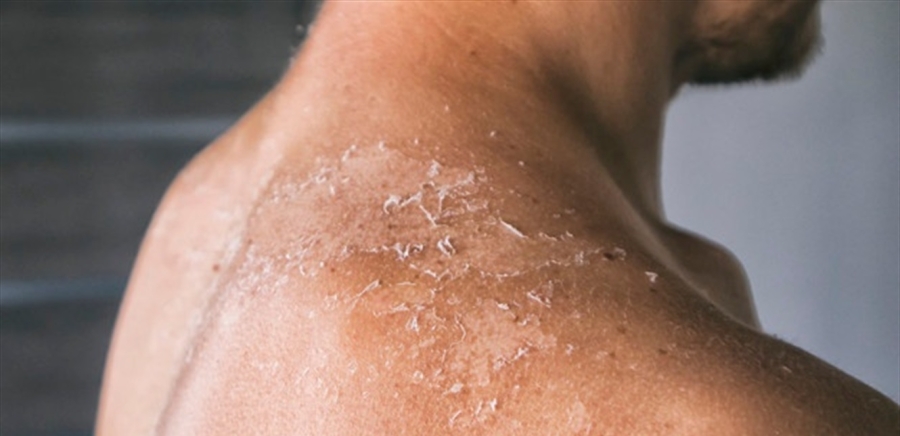 فرنسا تنتقد تريند حروق الشمس على تيك توك