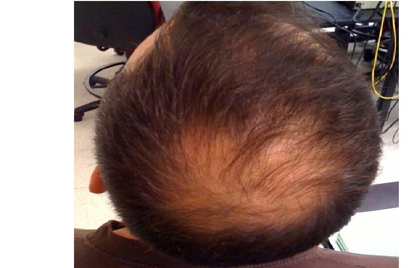 طبيبة تكشف أسباب تساقط الشعر وتحذر من العلاج الذاتي