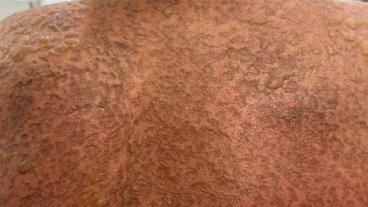 إنقاذ مصري من الموت بعد إصابته بمتلازمة نادرة