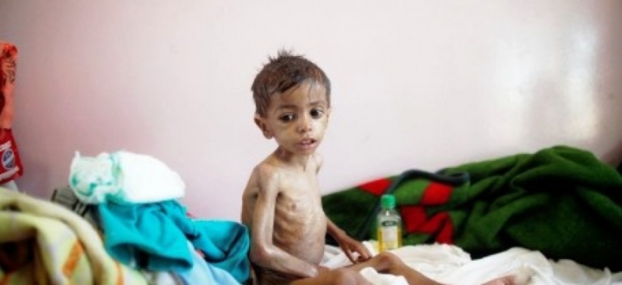 يسجل القطاع ارتفاعاً غير مسبوق في معدل سوء التغذية لدى الأطفال .