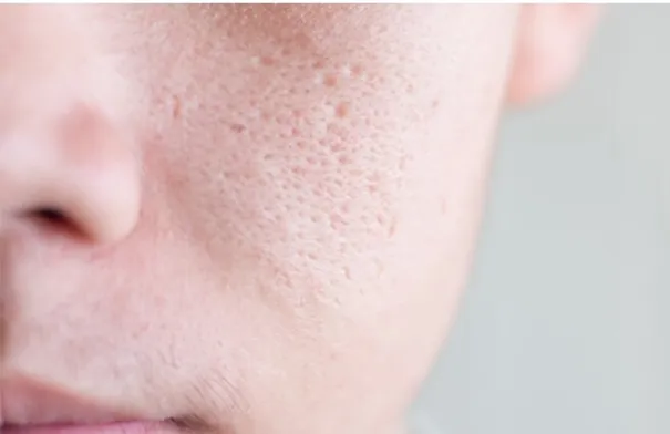 وصفات طبيعية لتقليص المسام الواسعة وتحسين مظهر البشرة