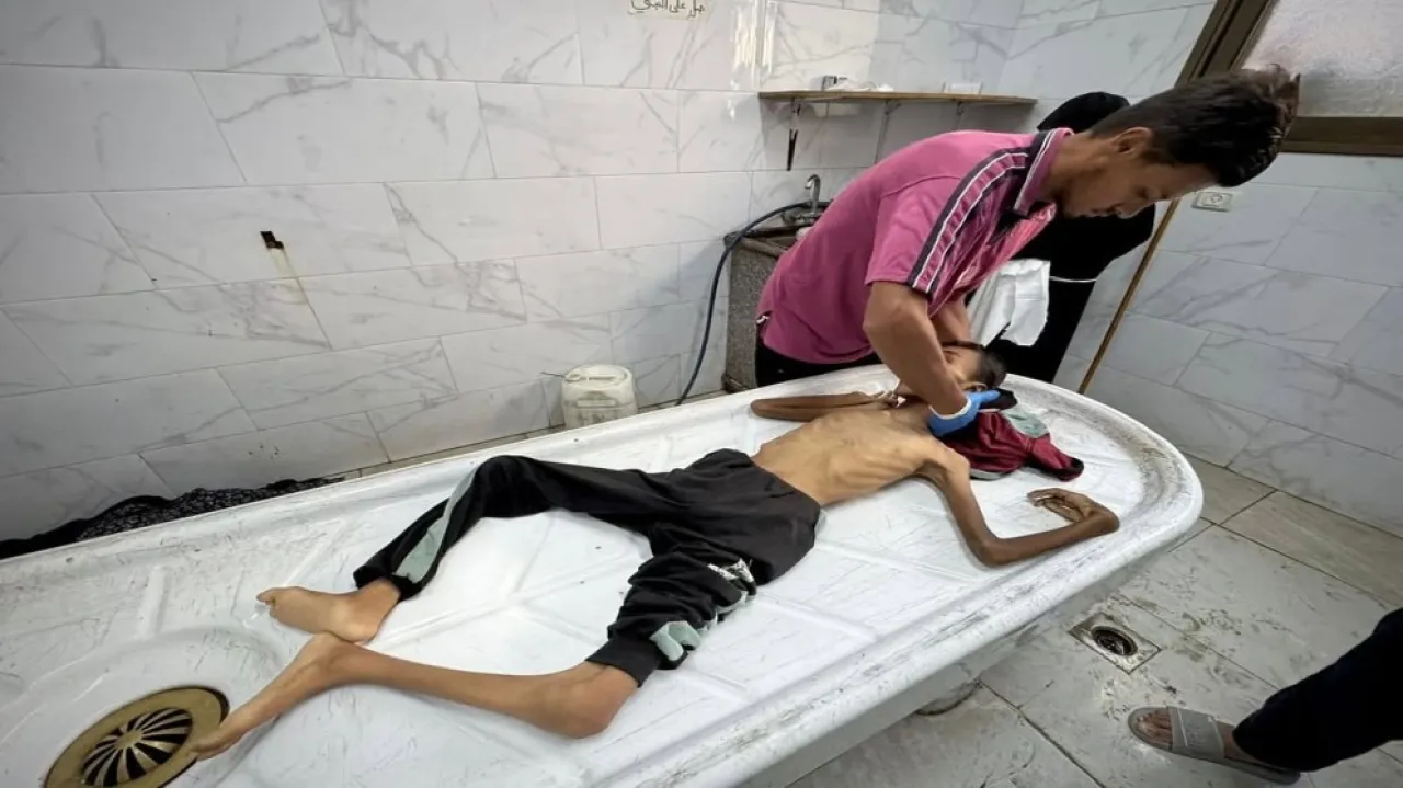 صحة غزة: 10 وفيات نتيجة المجاعة وسوء التغذية خلال الـ 24 ساعة الماضية