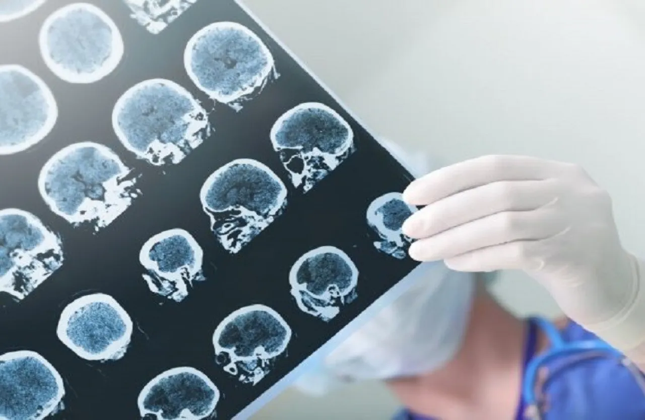 كيف تؤثر وجبة واحدة دسمة على دماغك؟!