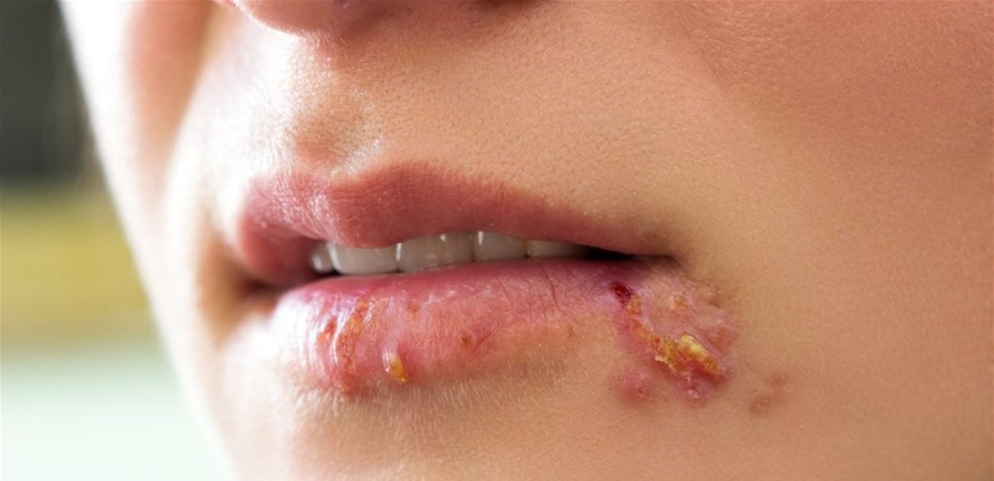 فيروسات الهربس.. الكشف عن وسيلة مبتكرة لمكافحتها