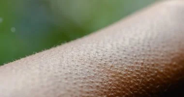 وصفات طبيعية للتخلص من جلد الوزة.. من ملح البحر لخل التفاح