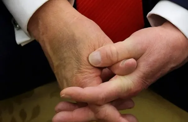 صورة حديثة ليد ترامب .. الكدمة ومساحيق التجميل تجددان الجدل