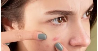 6 نصائح للتعامل مع حب الشباب خلال فترة المراهقة.. تجنب لمس الحبوب أبرزها