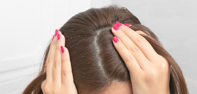 علاج القشرة بمكون طبيعي.. حل سحري لفروة الرأس