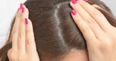 4 وصفات طبيعية تخلصك من القشرة من غير ما تنشف شعرك
