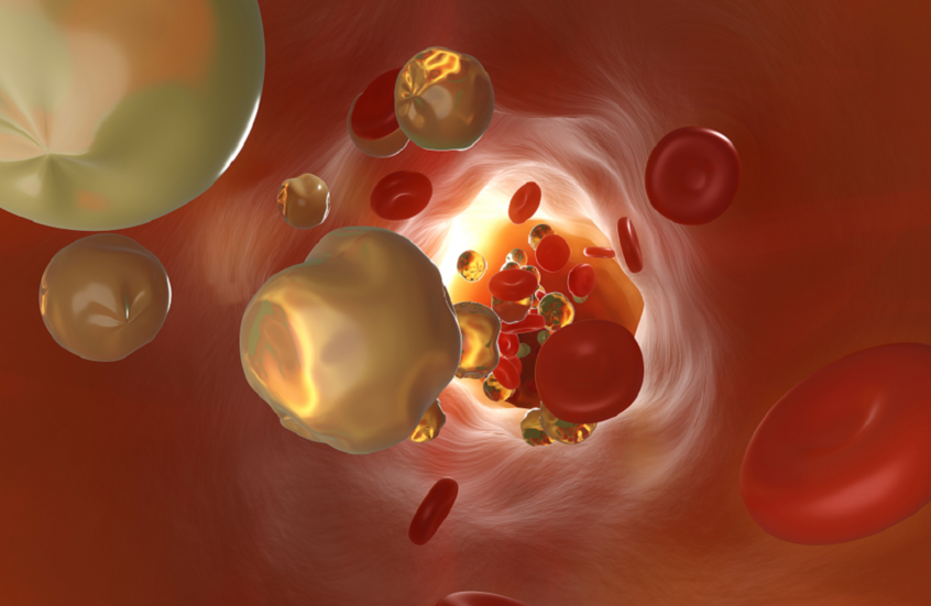 خفض الكوليسترول قد يحدّ من خطر الخرف