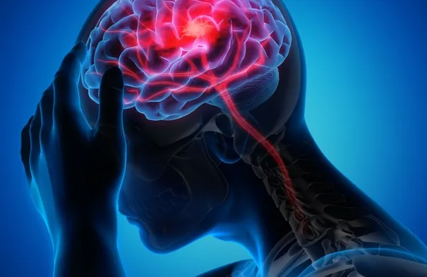 ارتفاع الجلطات الدماغية بين الشباب.. الأسباب والوقاية