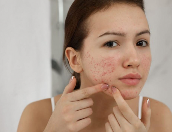 سيدتي .. علامات في وجهك تكشف عن اختلال التوازن الهرموني